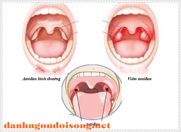 đi&ecirc;̀u trị chữa b&ecirc;̣nh vi&ecirc;m amiidan